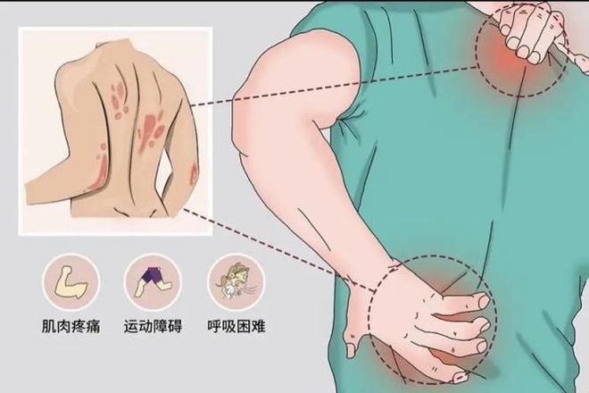 淋巴癌一型呼吸衰竭-淋巴癌患者的呼吸之痛：等待焦虑与生命之战