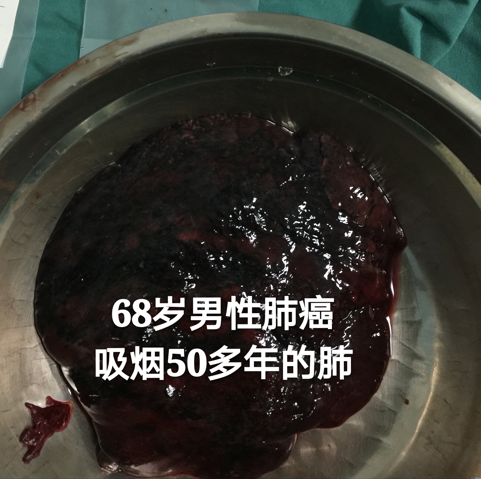 肺癌白蛋白_肺癌患者白蛋白还是球蛋白_肺癌蛋白质