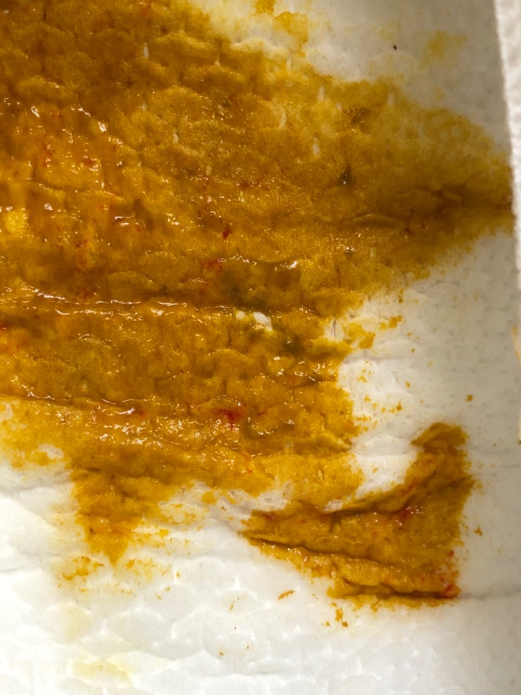 大便鲜血便_大便出鲜血严重吗_鲜血大便严重出血怎么办