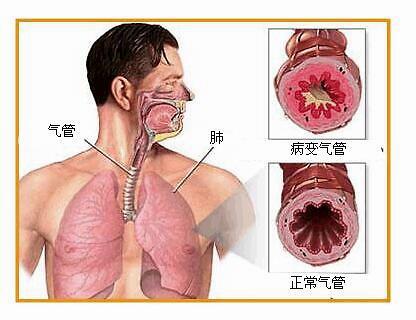 运动性哮喘的症状_运动型哮喘_运动性哮喘怎么运动