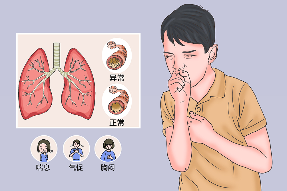 运动性哮喘的症状_运动型哮喘_运动性哮喘怎么运动
