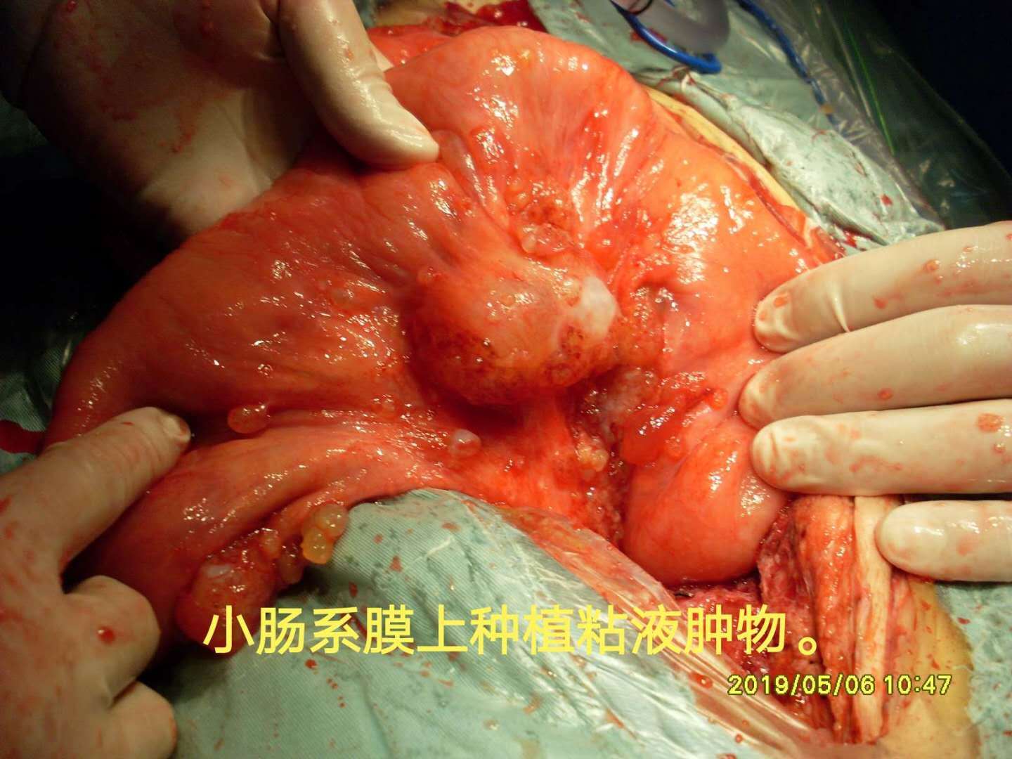 阑尾炎开刀了_阑尾炎开刀后有什么后遗症_阑尾炎开刀