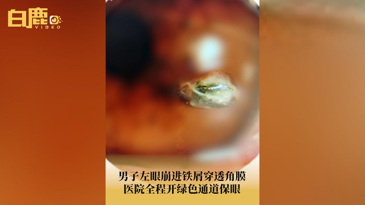 穿透性角膜移植术所致青光眼_穿透性角膜移植术所致青光眼_穿透性角膜移植术所致青光眼