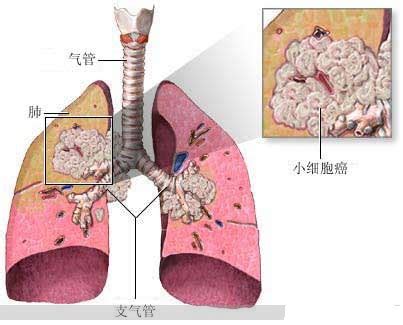 肺癌白蛋白高是怎么回事_白蛋白 肺癌_肺癌白蛋白低会有什么危险