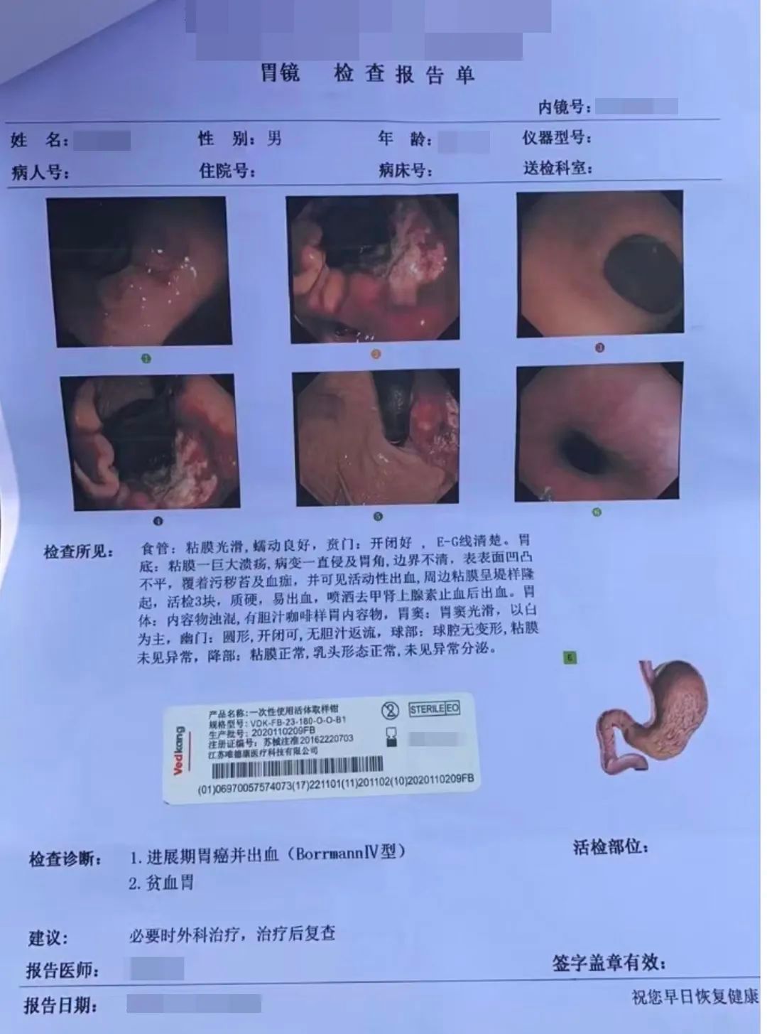 中医治疗胃溃疡大出血_中医辨证治疗胃溃疡出血_胃溃疡出血中医辩证