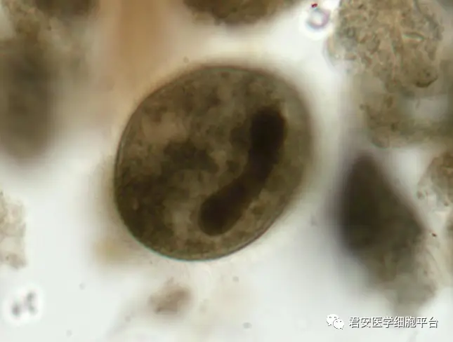 线样征,铅管征,跳跃征_跳跃征线样征_铅管征和线样征图片