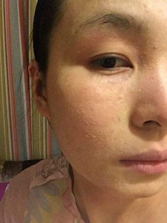 脸部一直脱皮什么原因-脱皮恼人：干燥？过度清洁？气候变化？