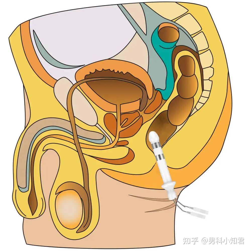 电击肛门睾丸失禁：探讨极端疗法的医学与伦理边界