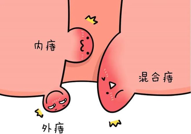 男同肛门失禁：原因分析与综合治疗建议
