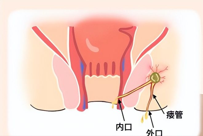 肛瘘手术多长时间好_多长手术好肛瘘时间久_多长手术好肛瘘时间长一点