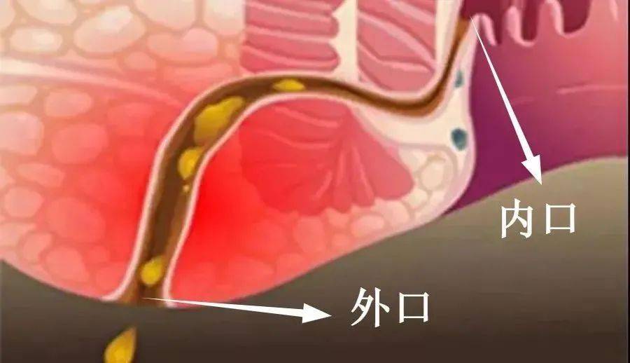 肛瘘手术多长时间好_多长手术好肛瘘时间长一点_多长手术好肛瘘时间久